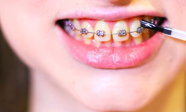 Брекети. Фото: YouTube