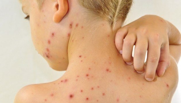 Днепр и область захлестнула вспышка опасной кори. Когда и где можно сделать прививку