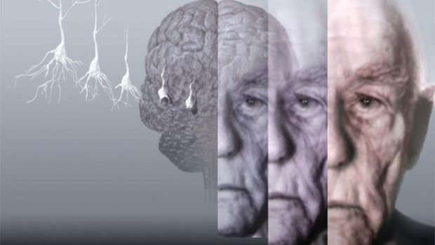 Ученые назвали единственный способ противостоять болезни Альцгеймера