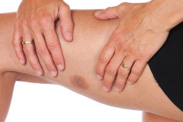 Синяки могут быть вестниками беды: медики предупредили об опасностях