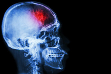 Это может привести к инсульту: названы популярные напитки, от которых стоит немедленно избавиться