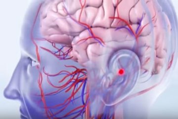 Инсульт. Фото: скриншот YouTube