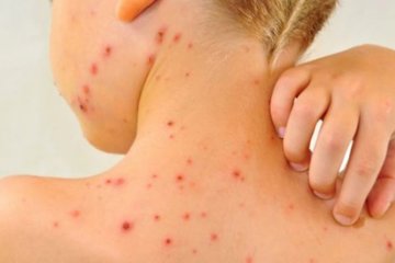 Корь, фото Фокус