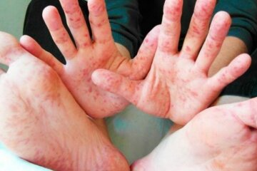 Корь нанесла удар по украинцам. Лето на больничной койке: первые данные