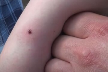 Клещ на теле. Фото: скриншот YouTube-видео